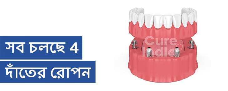 সব 4 টি ডেন্টাল ইমপ্লান্টে